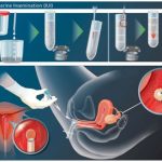 IUI-Treatment